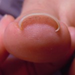 千種区仲田の巻き爪補正はサルース(SALUS)へ