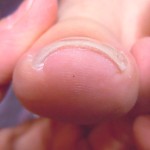 親指の爪が痛いなら千種区池下のサルース(SALUS)へ