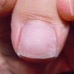 痛みのある爪は千種区のサルース(SALUS)池下店で解消