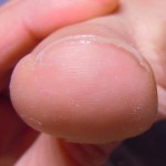 巻いた爪を何とかしたいなら池下駅チカのサルース(SALUS)池下店へ